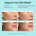 Azelaic Acid Cream for Sensitive Skin